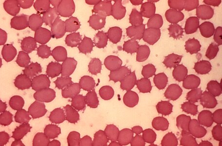 Bacteria blood cervical smear photo