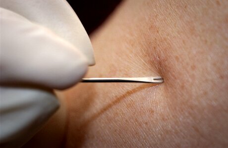 Bifurcated Needle close close-up