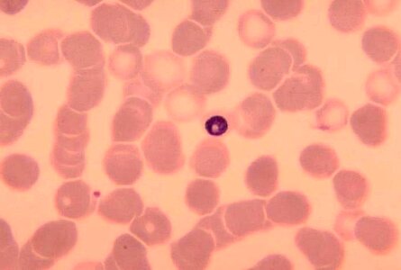 Ancient blood cervical smear