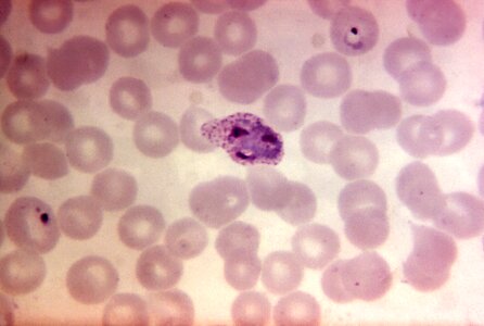 Blood cervical smear presence photo