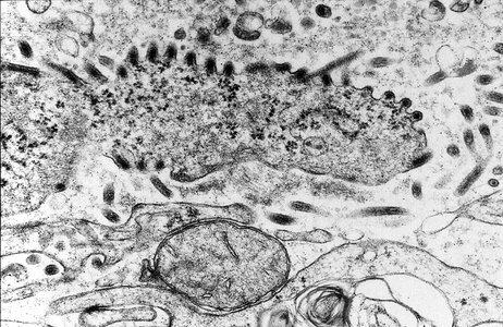 Fever hemorrhagic fever infection