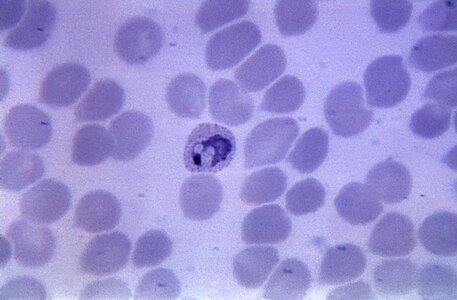 Blood cervical smear crescent photo