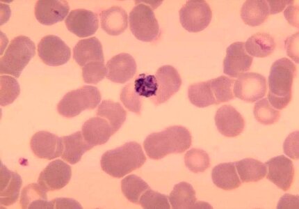 Ancient blood cervical smear