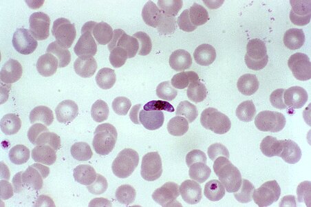 Blood cervical smear parasit photo