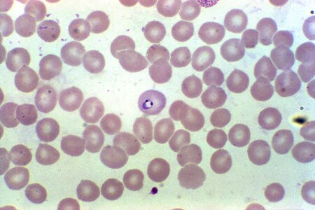 Blood cervical smear parasit photo