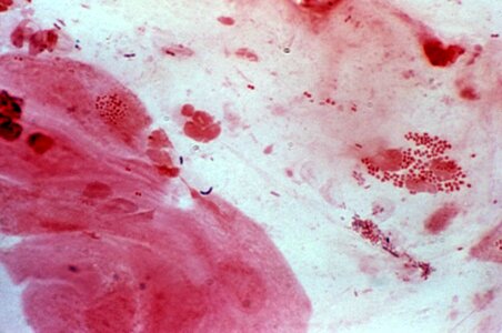 Cervical Smear gram photomicrograph