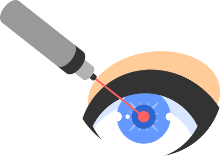 Laser Eye Correction Depicted in Medical Precision