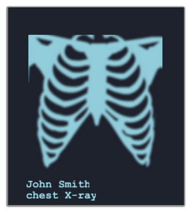 Chest x-ray image