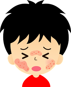 Skin rash - dermatitis, eczema, or hives