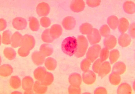 Blood cervical smear parasit photo