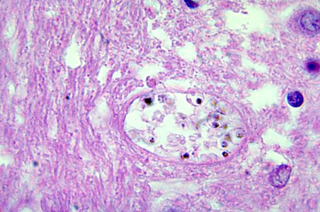 Brain histopathology malaria