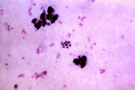 Blood cervical smear photomicrograph