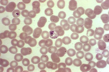 Blood cervical smear photomicrograph photo