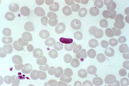Blood cervical smear parasit