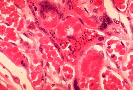 Histopathology malaria placenta photo