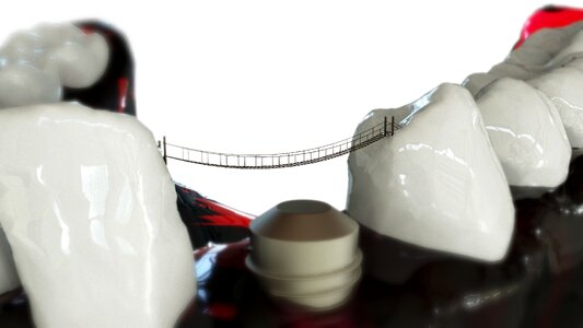 Orthodontics the implant bridge