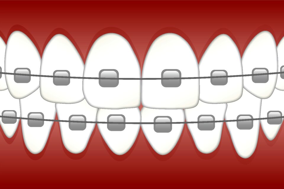 Dentistry orthodontics tooth
