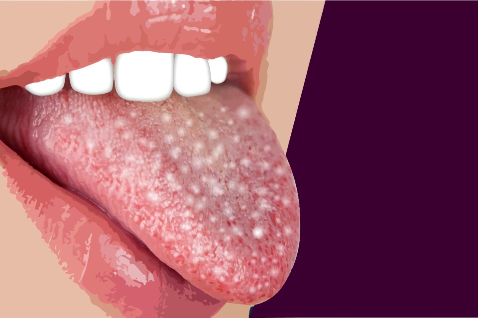 Tongue patches dentist
