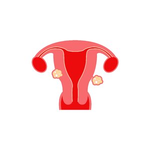 Fibroids model fibroids types Free illustrations