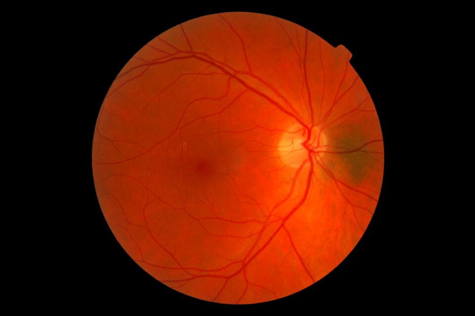 Nevus eye Free illustrations