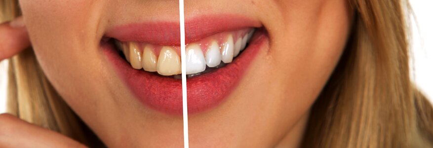 White teeth hygiene dental hygiene