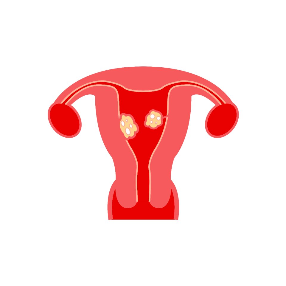 Fibroids model fibroids types Free illustrations