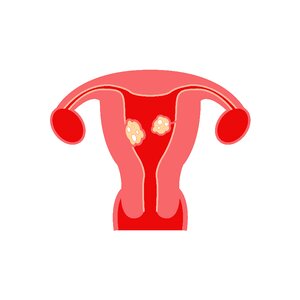 Fibroids model fibroids types Free illustrations