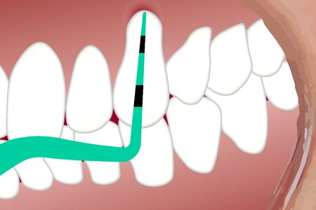 Teeth unhealthy white