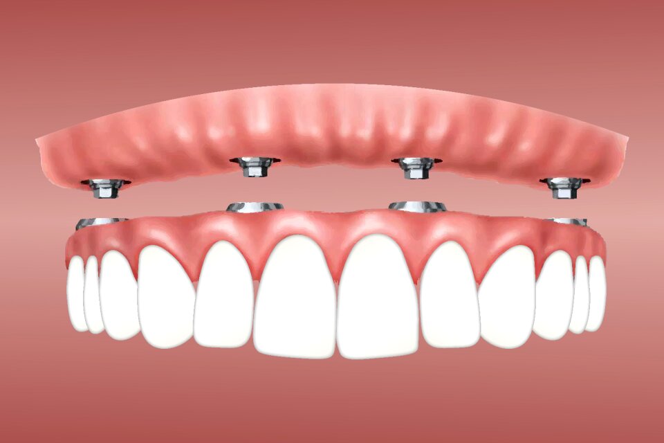 Gum supported jaw dentist