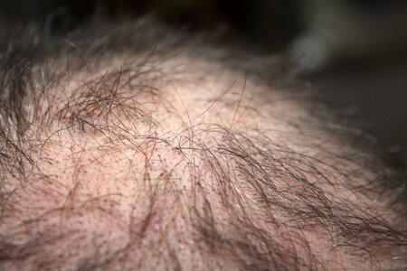 Man hair loss head