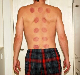 Acupuncture marks chinese photo