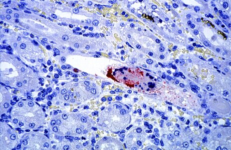 Disease fever nervous system