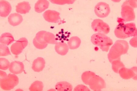 Blood cervical smear found photo