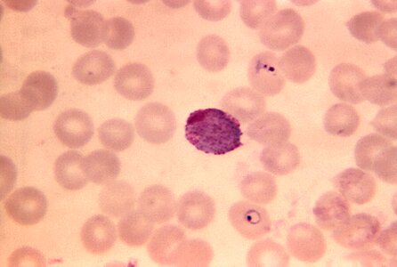 Blood cervical smear photomicrograph