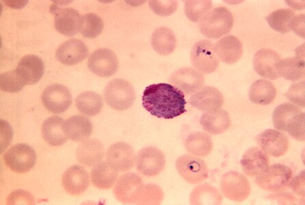 Blood cervical smear photomicrograph photo