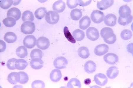 Blood cervical smear parasit photo