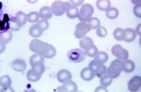 Crescent plasmodium teenage photo