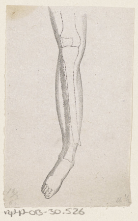 Menselijk onderbeen met een breuk in het bot, RP-P-OB-30.526, Isaac Weissenbruch, between 1836 and 1912