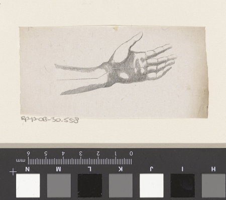 Menselijke pols met een breuk in het bot, RP-P-OB-30.558, Isaac Weissenbruch, between 1836 and 1912