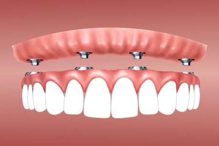 Gum supported jaw dentist. Free illustration for personal and commercial use.