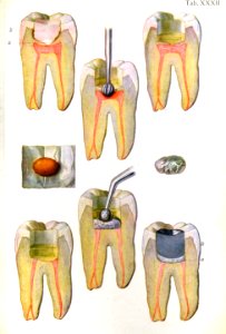 Pulpotomy
