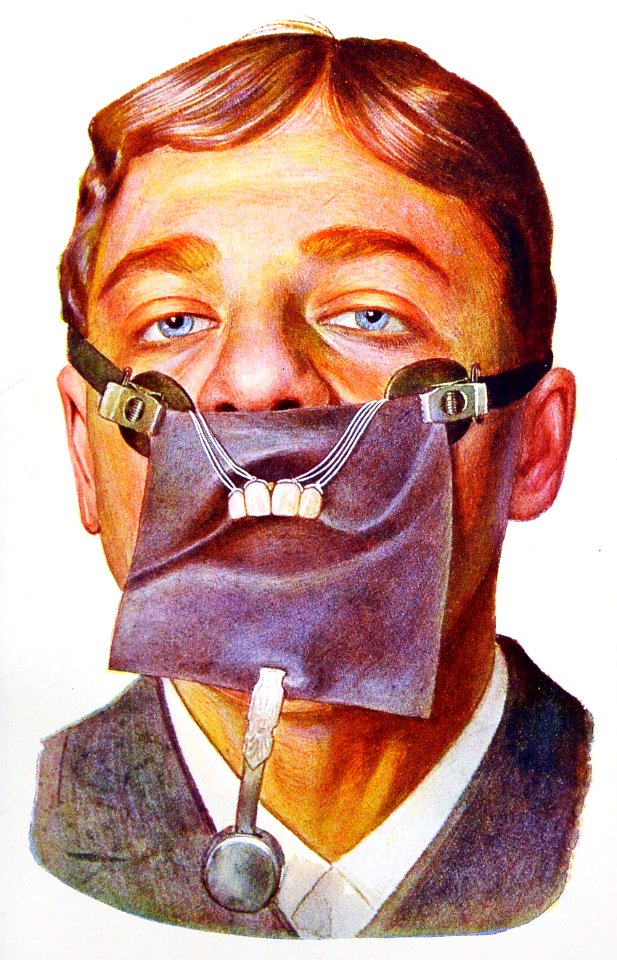 Dental Dam Applied to Upper Teeth