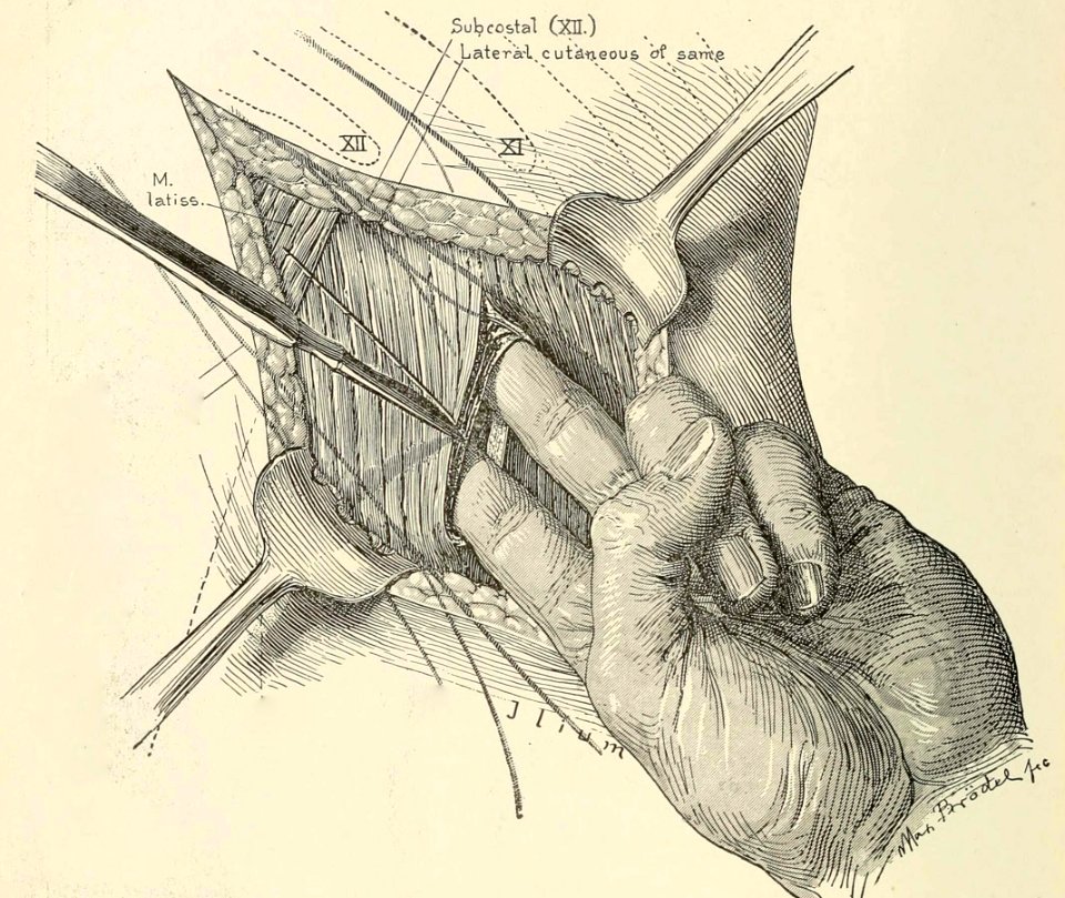 Muscle-Splitting Incision