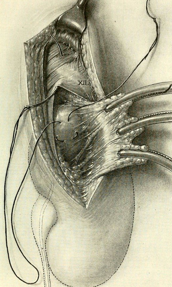 Suspension of the Kidney
