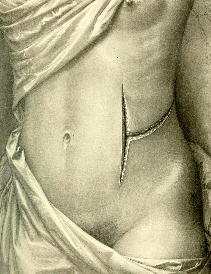 T-Shaped Incision