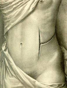 T-Shaped Incision