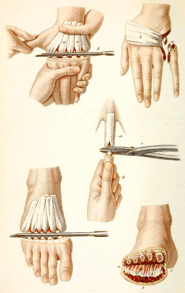 Amputations in the Continuity of the Bones