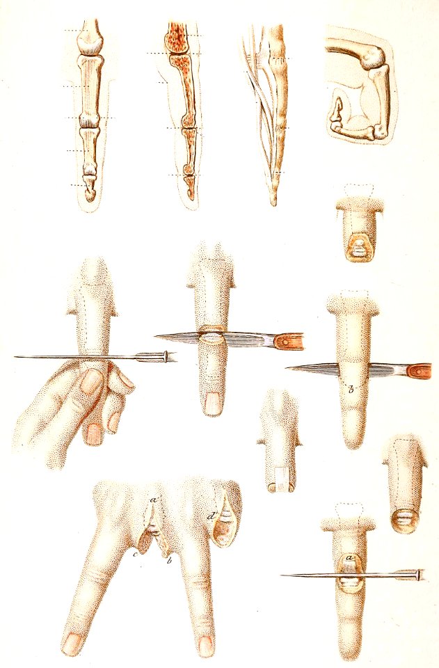 Disarticulation of Phalanges and Finger