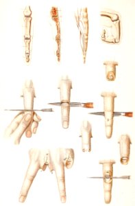 Disarticulation of Phalanges and Finger