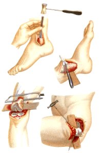 Resections Performed on the Lower Extremity